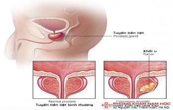 Ung thư tuyến tiền liệt: Triệu chứng và Nguyên nhân